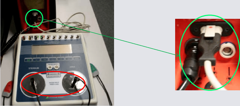 除颤分析仪心律分析